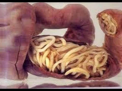 Medicina di carbonato di sodio per vermi Il troychatka da parassiti quanti accettare