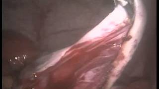 preview picture of video 'LAPAROSCOPIC ovarian endometrioma / CHOCOLATE CYST EXCISION'
