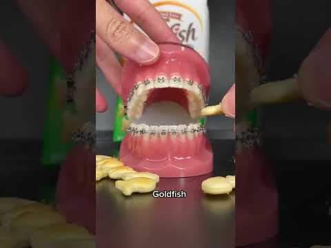 Unhealthy Snacks You Can Eat with Braces