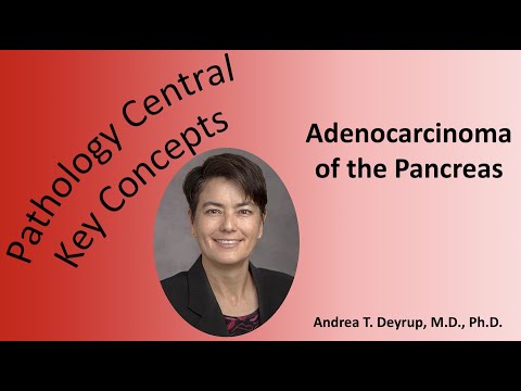 Medical School Pathology: Adenocarcinoma of the Pancreas