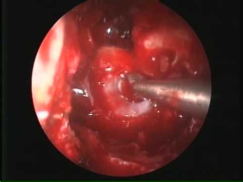 Endoscopic transnasal transsphenoidal resection of pituitary macroadenoma