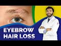 How Often Do Eyebrow Hairs Fall Out