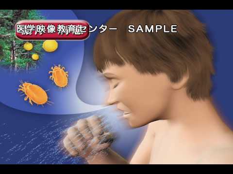 脂肪族アミン 呼吸器疾患 (職業病) - 定義