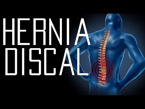 Hernia discal: todo lo que necesitas saber