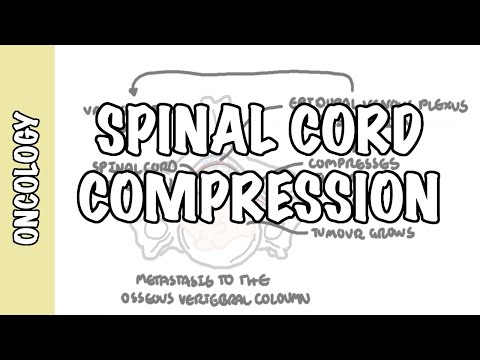 Spinal Cord Compression -  Medical Emergency, Causes, Symptoms, Diagnosis, Treatment