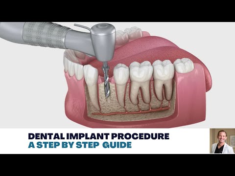 Dental Implant Procedure: A Step by Step Guide