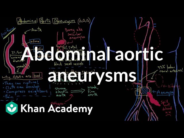 Video Pronunciation of abdominal aortic aneurysm in English