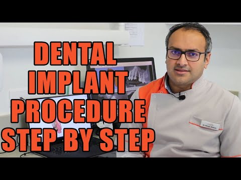 Dental Implants Procedure Step by Step || How Dental Implants are Put In || Dental Implant Surgery