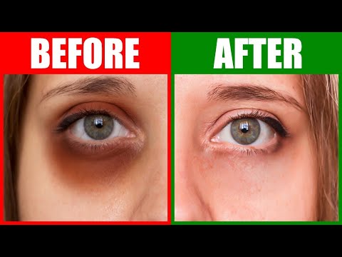 Fix the Root Cause of Dark Circles Under the Eyes