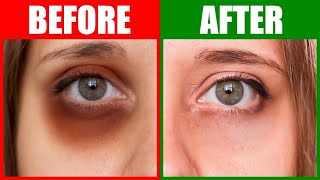 Fix the Root Cause of Dark Circles Under the Eyes