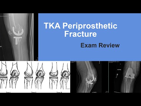 TKA Periprosthetic Fracture Exam Review - Matt Austin, MD