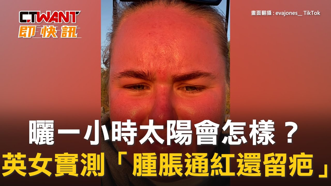 圖說-曬一小時太陽會怎樣？　英女實測「腫脹通紅還留疤」