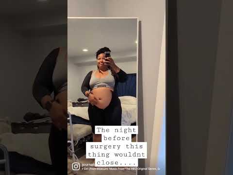 From pre-op to 3 weeks posts-op plus-size mommy makeover