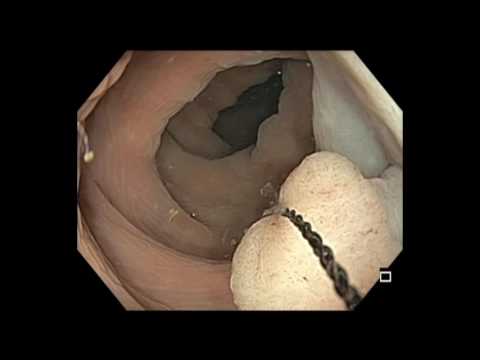 Colonoscopy: Sigmoid colon polyp resection