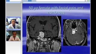 Download Lagu Transpetrosal Approach: Indications and a Video Review of Cases (Preview) Thumbnail