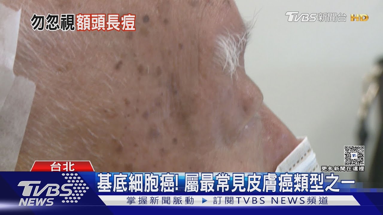 別以為只是痘痘！妙齡女額頭紅腫數月　竟驗出皮膚癌！