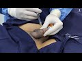 Non Surgical Penile Enlargement Penilefiller Biggerpenis Penisfiller