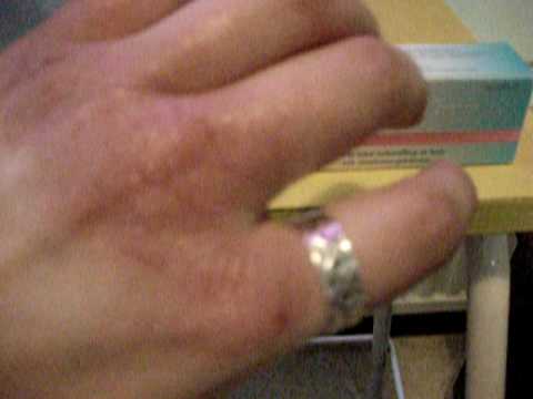 Kuumottaa ja kirvelee käsiä