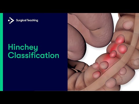 Hinchey classification