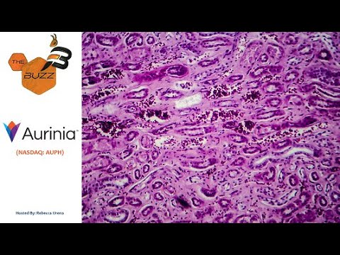 “The Buzz” Show: Aurinia Pharmaceuticals (NASDAQ: AUPH) Receives FDA Approval for LUPKYNIS