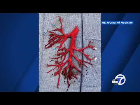 Man coughs up blood clot in perfect shape of bronchial tree