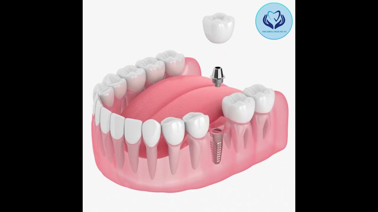 Quy trình cắm implant nha khoa 470