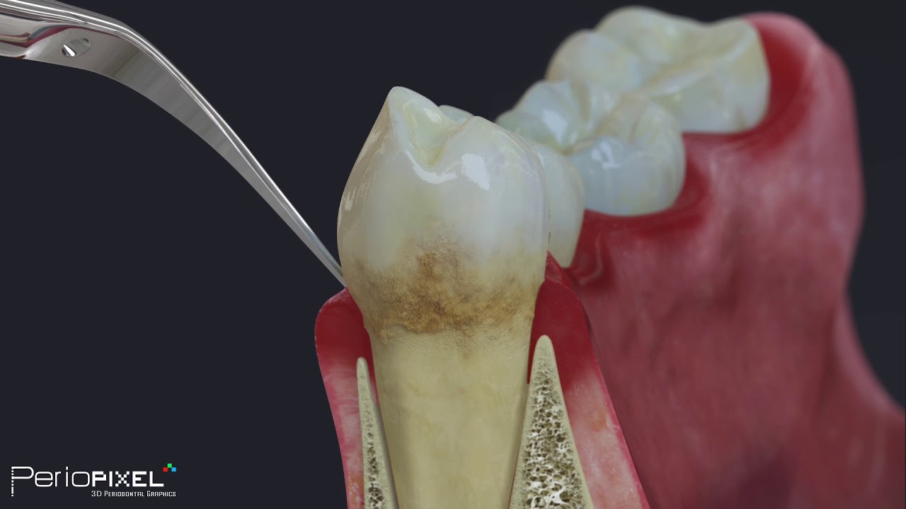 Tratamiento Periodontal Básico para pacientes