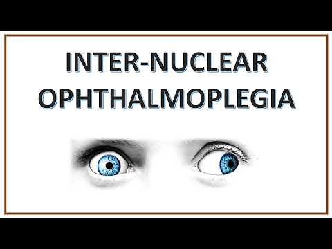 Internuclear Ophthalmoplegia | INO | WEBINO Syndrome | One and Half Syndrome
