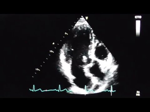 Apical long axis view (APLAX-view)