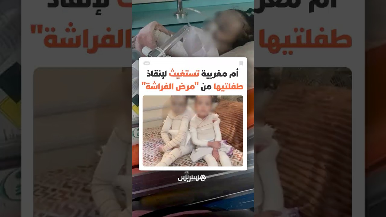 "جلدهما يتلاشى مع كل لمسة".. أم مغربية تكشف مأساة "مرض الفراشة" وتستغيث لإنقاذ ابنتيها thumbnail