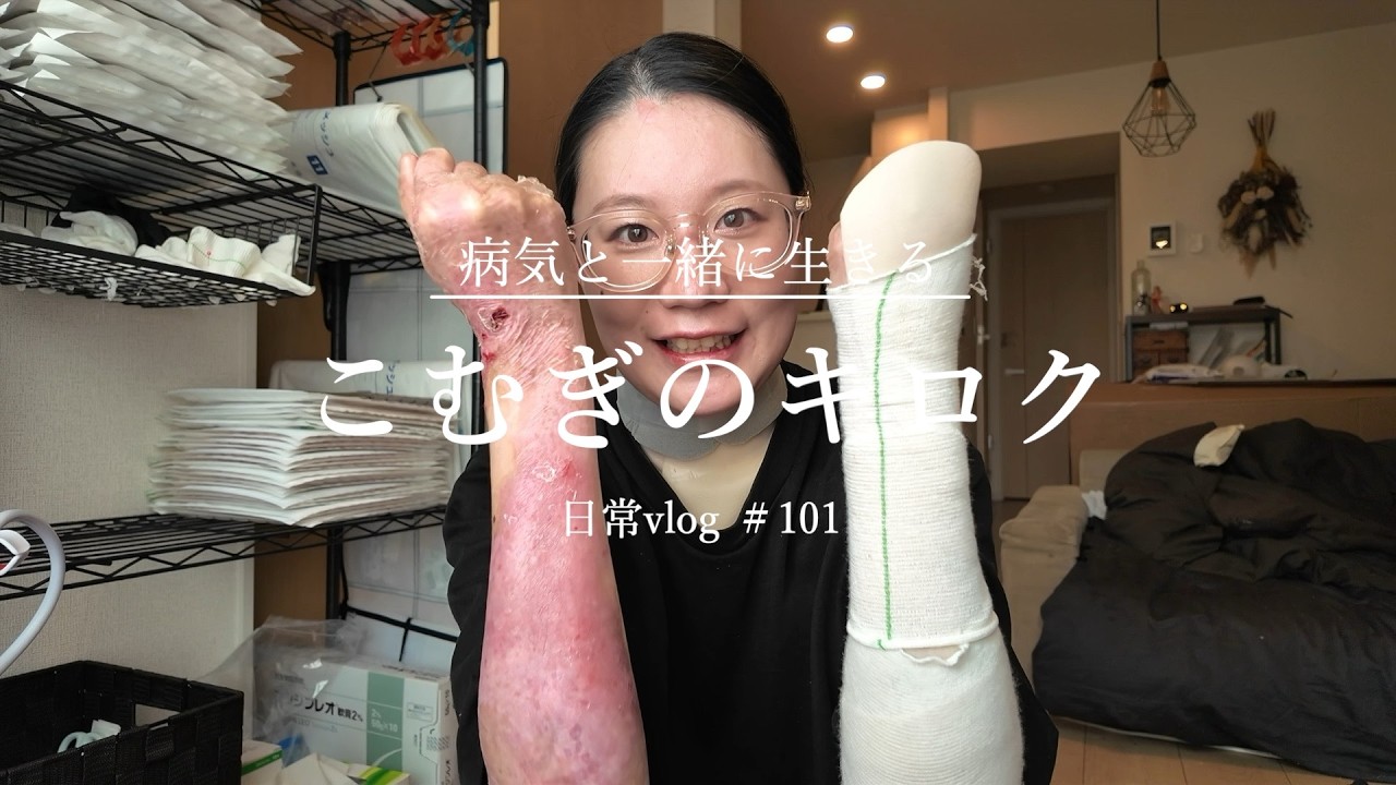 【表皮水疱症】現在やっている治療や身体の状態などの現状まとめ　日常vlog＃101