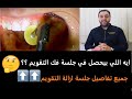 فك تقويم الاسنان ايه اللي بيحصل في جلسة فك التقويم ؟