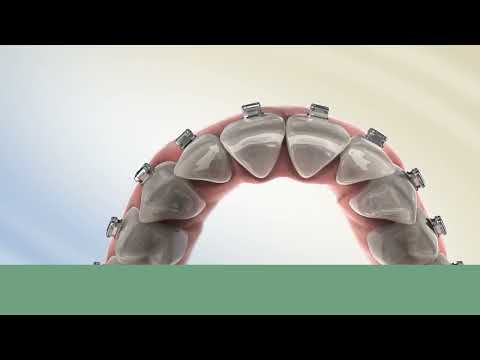 Logo of Damon Braces in the USA: Comprehensive Guide to Faster, Discreet Orthodontics