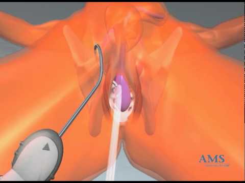 Antibiotika-Behandlung von Prostata Bei der Behandlung von Prostatitis Masturbation