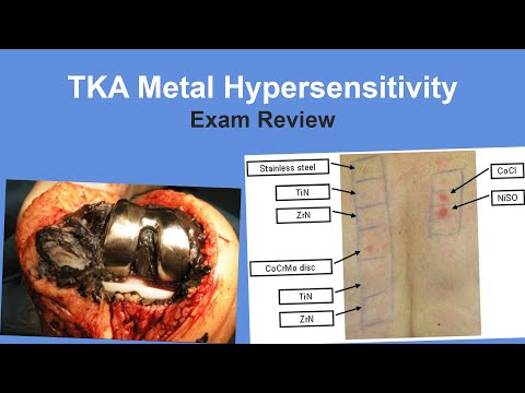 TKA Metal Hypersensitivity Exam Review. - Thomas Sculco, MD