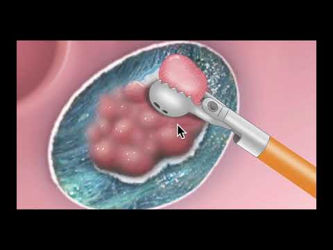 Colonoscopy:Tethered Polyp Resection - Graphic Illustration