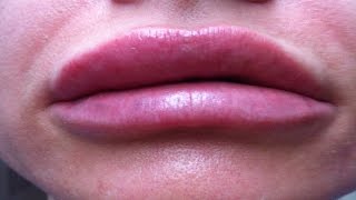 How to get Rid of a swollen lip fast | Home remedies | Swollen upper lip