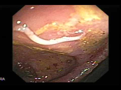 Se è possibile eliminare vermi di fame Prevenzione di lyambliya da medicine