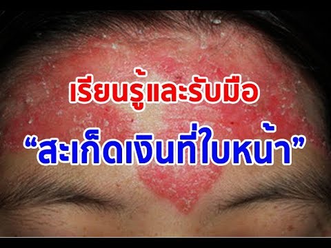 คลินิกรักษาโรคสะเก็ดเงินใน Rostov Lorindenom รักษากลาก