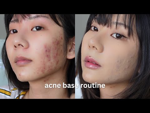 acne skin ʚɞ ༘⋆ acne coverage base routine | cover acne easily with makeup