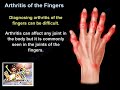 Arthritis Of The Fingers - Everything You Need To Know - Dr. Nabil Ebraheim