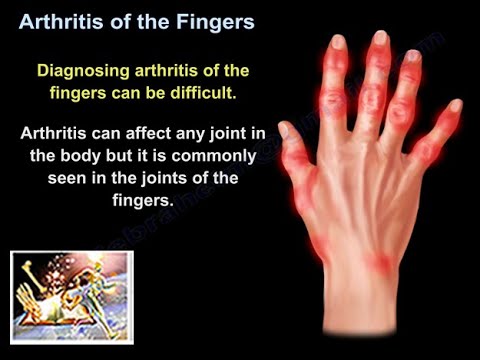 A kezek szeronegatív rheumatoid arthritis