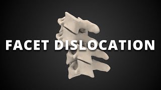 Facet dislocation: unilateral, subluxation, perched, and locked facets