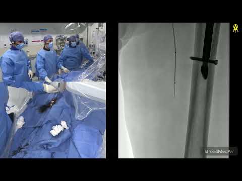 Endovascular Treatment For CTO Of Left Popliteal Artery