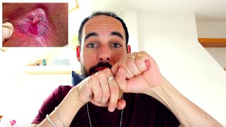 FISURA ANAL: Mi experiencia