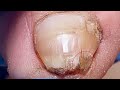Trim Super Thick Toenails Thinning Layer By Layer