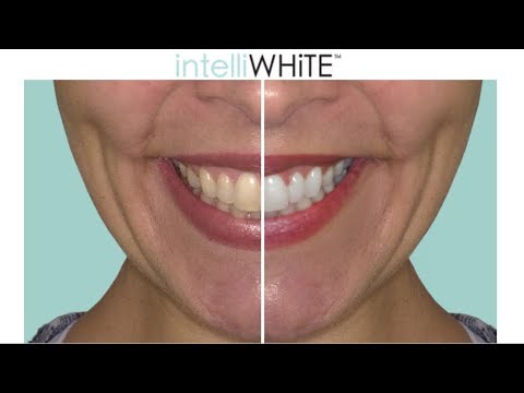 IntelliWHiTE Teeth Whitening System - intelliWHiTE.com