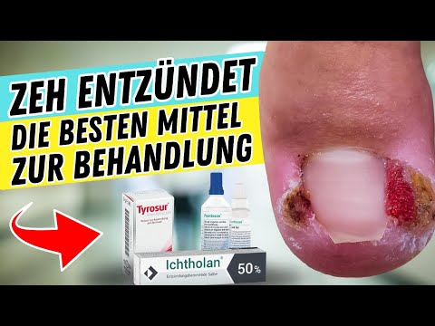 ZEH ENTZÜNDET? So behandelst du ihn | Die besten Mittel gegen ENTZÜNDETE ZEHEN & NAGELBETTENTZÜNDUNG