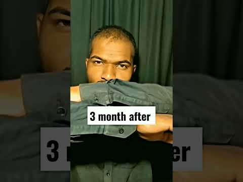 minoxidil or finasteride 3 month hair growth result @AvinashJadhavHairCare #shorts