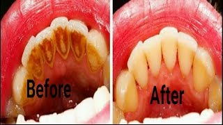 How to Remove Yellow Stains from Teeth at Home